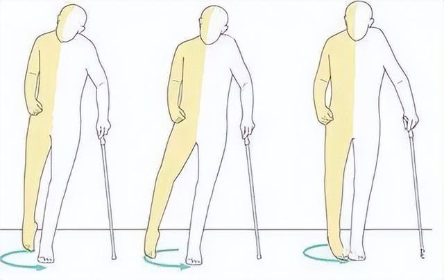 偏瘫如何进行综合的治疗