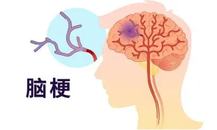 时间就是大脑！认识“脑梗死”
